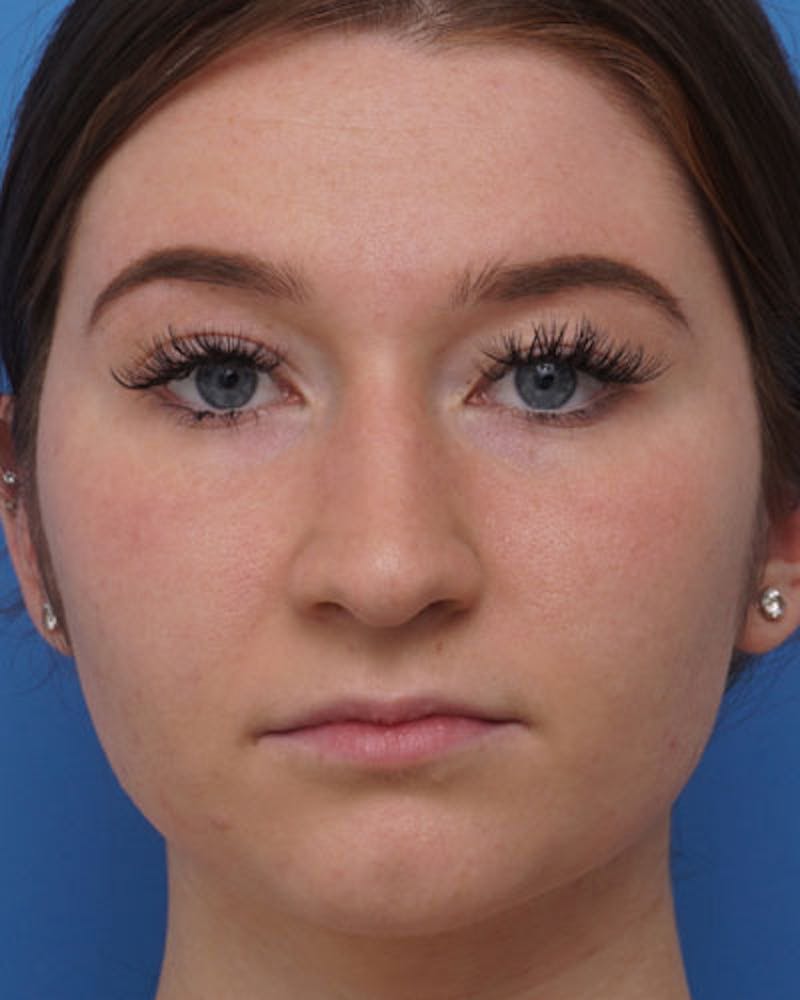 Rhinoplasty Before & After Gallery - Patient 227683 - Image 3