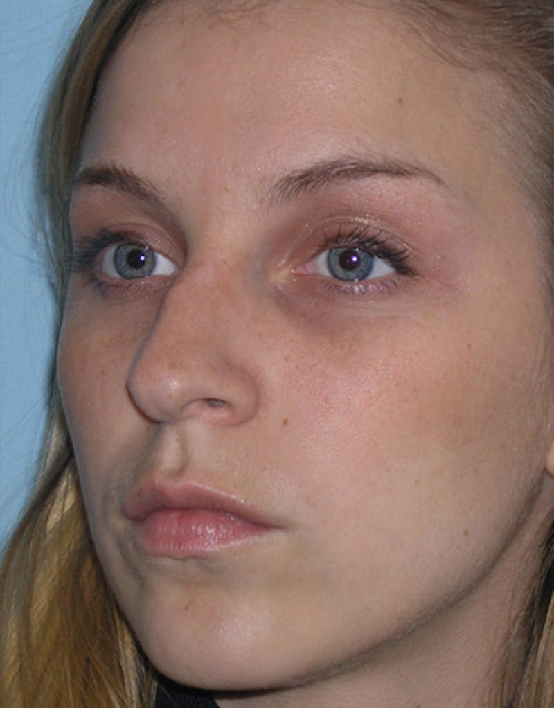 Foundation Rhinoplasty / Crooked Nose Before & After Gallery - Patient 161556 - Image 7