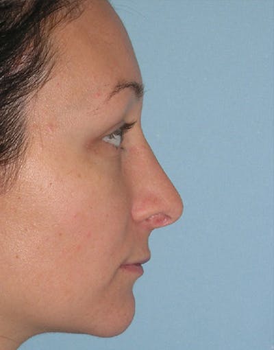 Rhinoplasty Before & After Gallery - Patient 186035 - Image 1