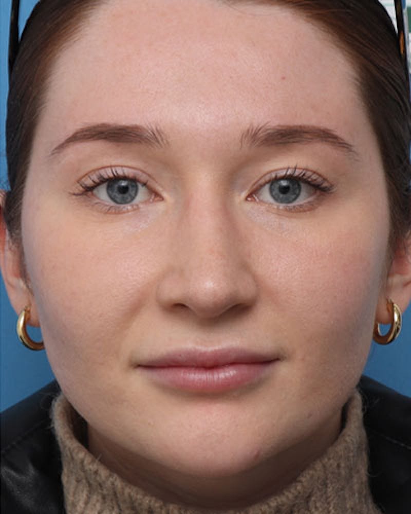 Rhinoplasty  Before & After Gallery - Patient 180988 - Image 4