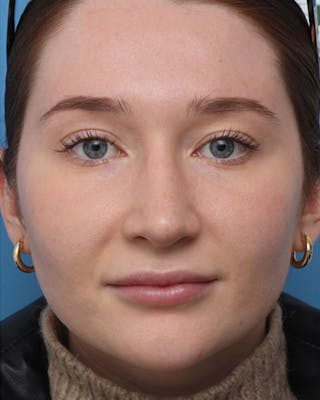 Rhinoplasty Before & After Gallery - Patient 180988 - Image 4
