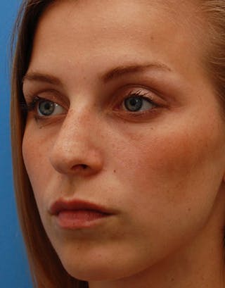 Favorite Foundation Rhinoplasty / Crooked Nose Before & After Gallery - Patient 294496 - Image 8