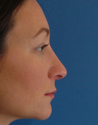 Rhinoplasty Before & After Gallery - Patient 186035 - Image 2