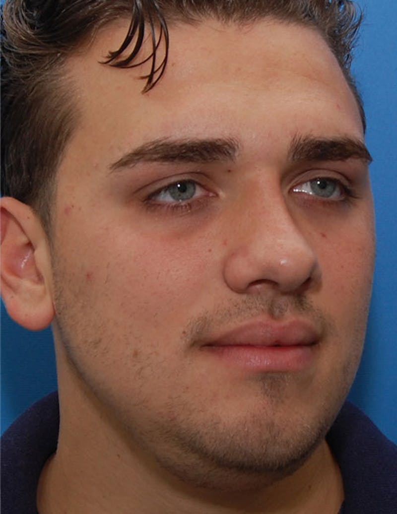 Male Rhinoplasty Before & After Gallery - Patient 239463 - Image 6