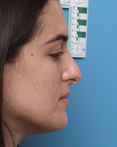 Rhinoplasty Before & After Gallery - Patient 411546 - Image 1