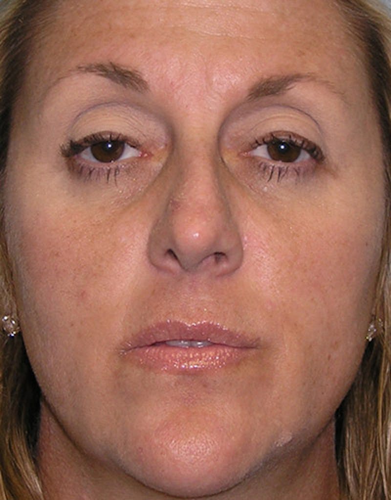 Foundation Rhinoplasty / Crooked Nose Before & After Gallery - Patient 352976 - Image 1