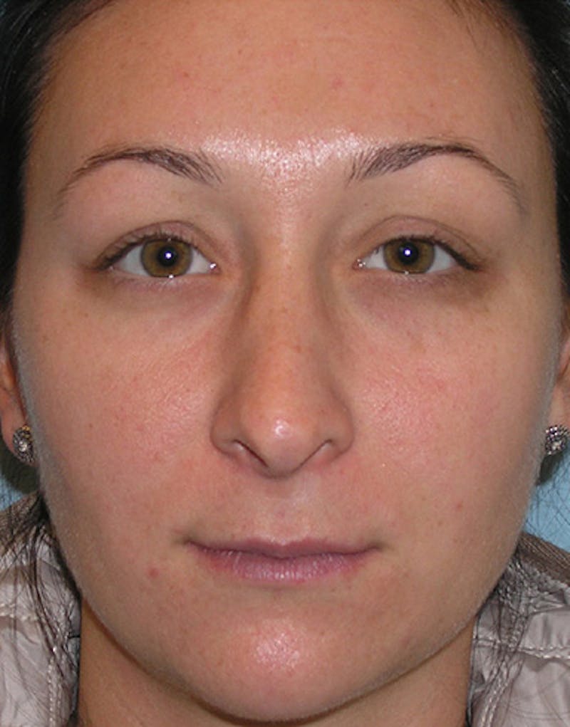 Revision Rhinoplasty Before & After Gallery - Patient 421156 - Image 3