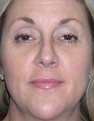 Rhinoplasty Before & After Gallery - Patient 308834 - Image 2