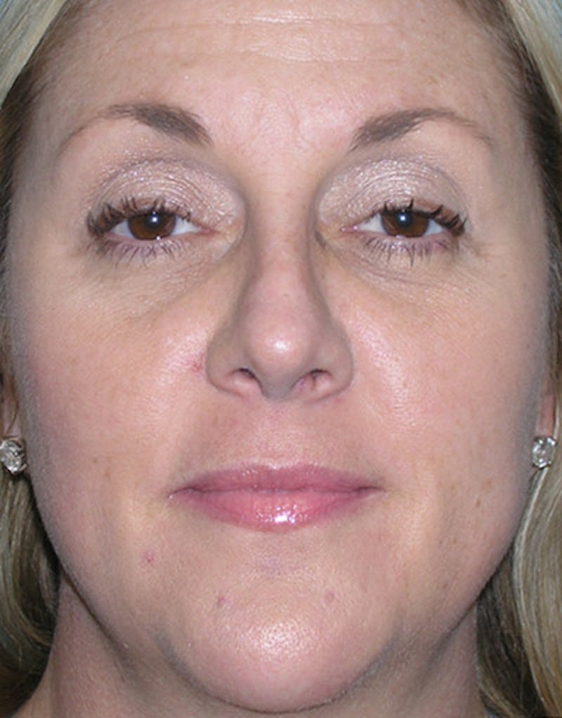 Foundation Rhinoplasty / Crooked Nose Before & After Gallery - Patient 352976 - Image 2