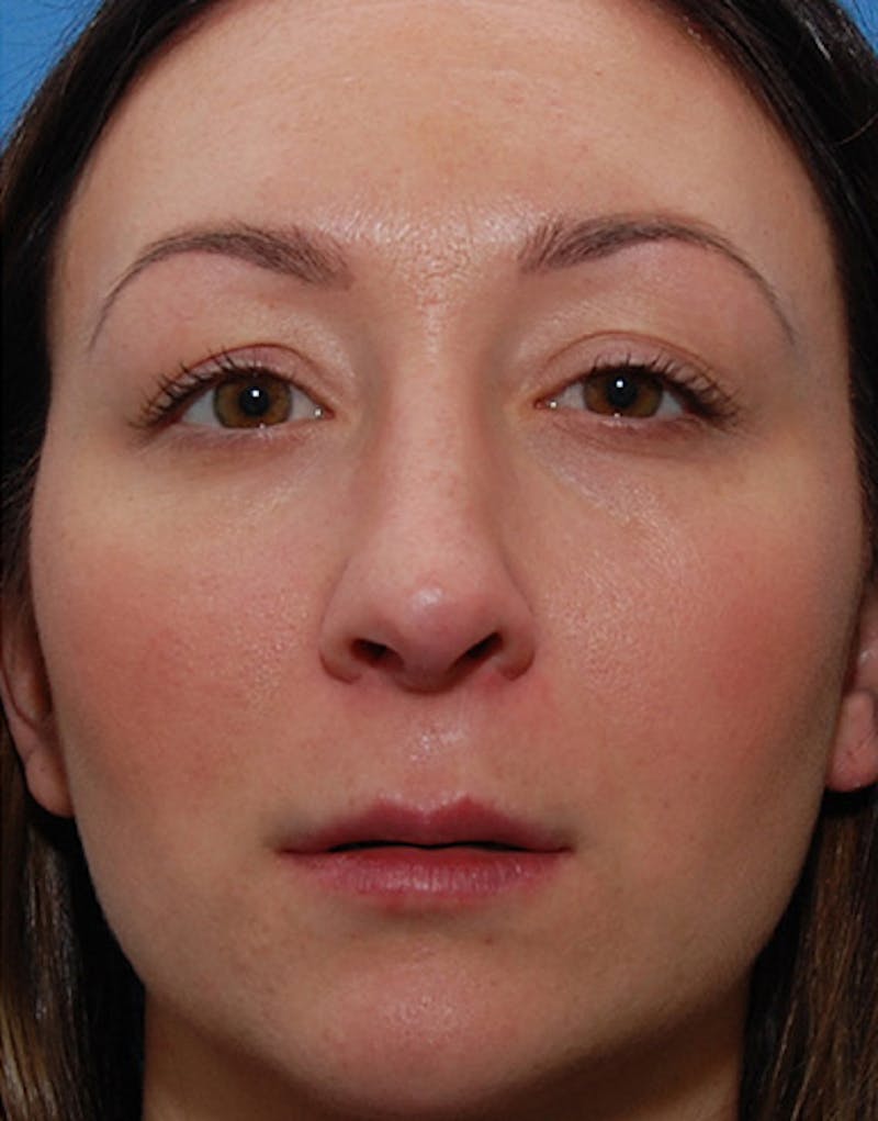 Revision Rhinoplasty Before & After Gallery - Patient 421156 - Image 4
