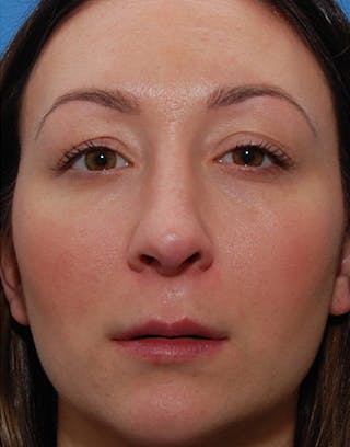 Rhinoplasty Before & After Gallery - Patient 186035 - Image 4