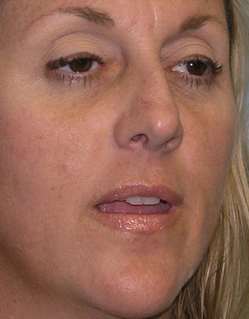 Foundation Rhinoplasty / Crooked Nose Before & After Gallery - Patient 352976 - Image 3