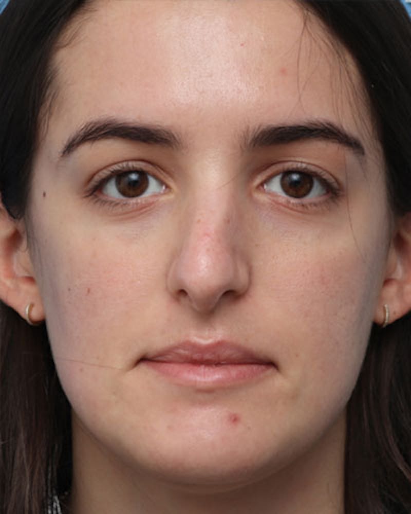 Rhinoplasty Before & After Gallery - Patient 400058 - Image 3