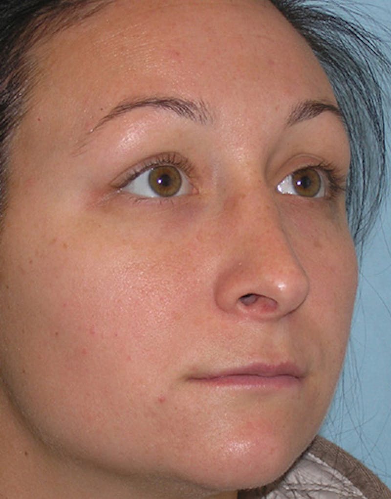Revision Rhinoplasty Before & After Gallery - Patient 421156 - Image 5