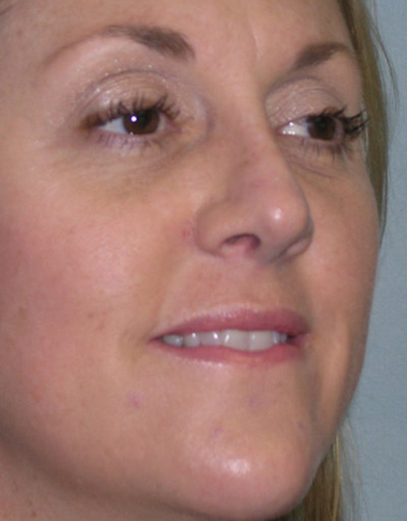 Foundation Rhinoplasty / Crooked Nose Before & After Gallery - Patient 352976 - Image 4