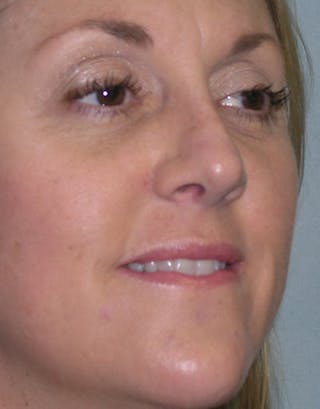 Rhinoplasty Before & After Gallery - Patient 308834 - Image 4