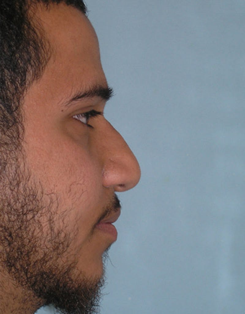Male Rhinoplasty Before & After Gallery - Patient 223341 - Image 1