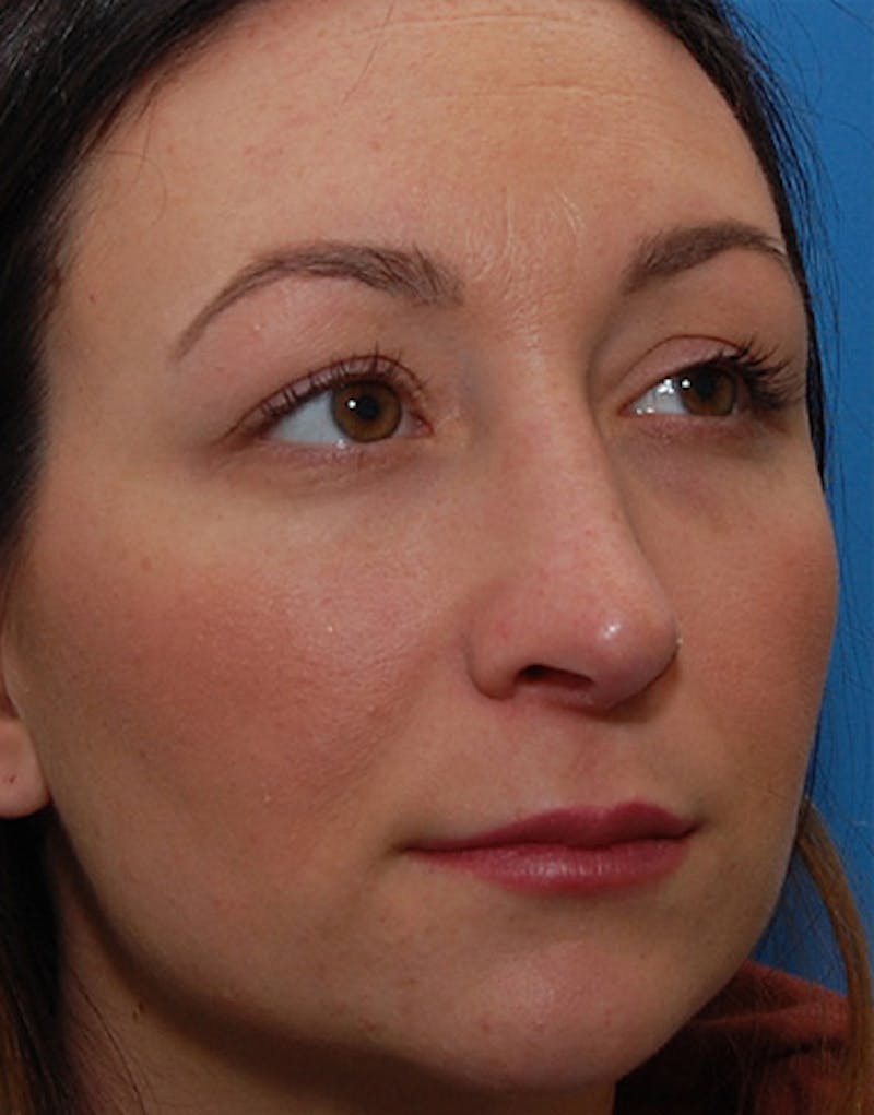 Revision Rhinoplasty Before & After Gallery - Patient 421156 - Image 6