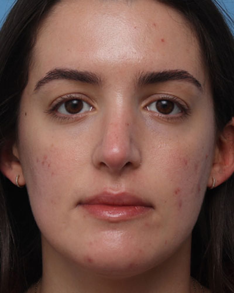 Rhinoplasty Before & After Gallery - Patient 400058 - Image 4