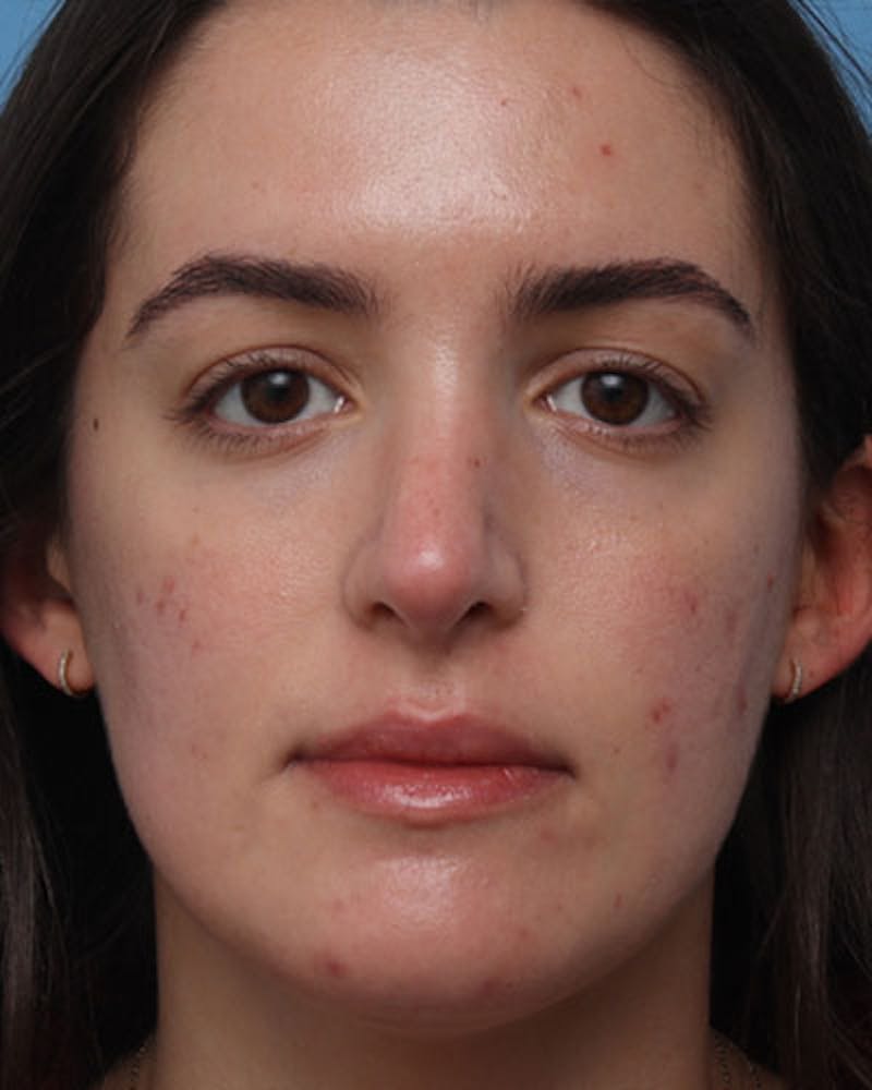 Rhinoplasty  Before & After Gallery - Patient 411546 - Image 4