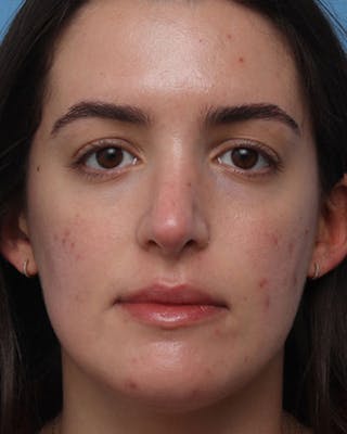 Rhinoplasty Before & After Gallery - Patient 411546 - Image 4