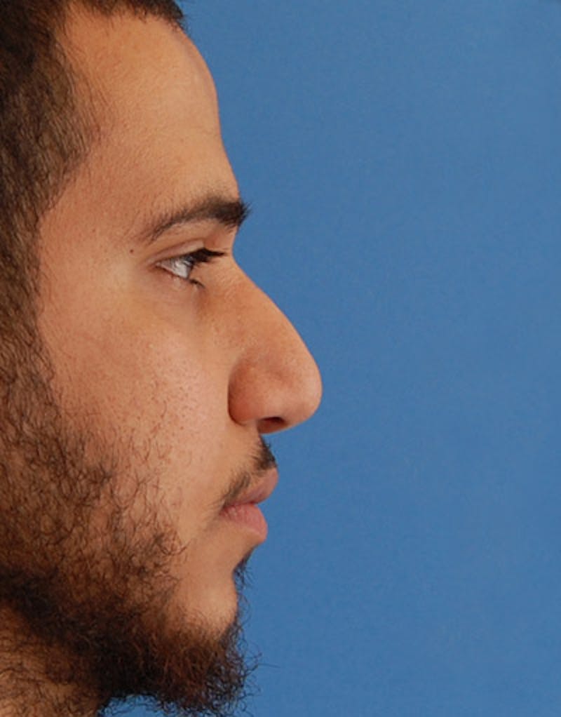 Male Rhinoplasty Before & After Gallery - Patient 223341 - Image 2