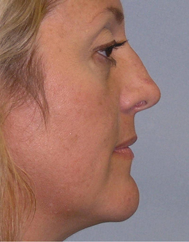 Foundation Rhinoplasty / Crooked Nose Before & After Gallery - Patient 352976 - Image 5