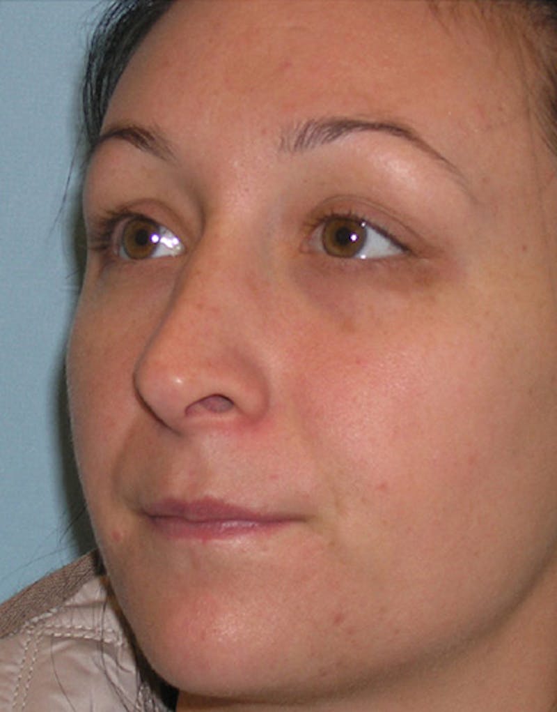 Revision Rhinoplasty Before & After Gallery - Patient 421156 - Image 7