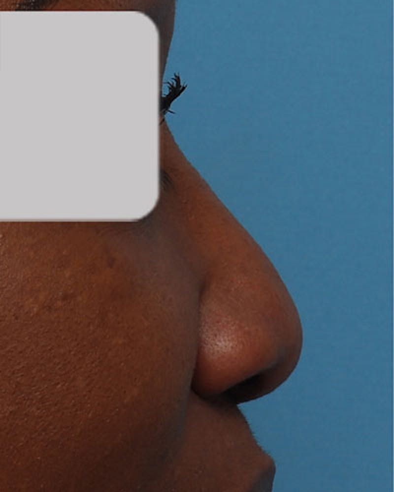 Patient RRollmNOSCakTiWYXJgRrA - Ethnic Rhinoplasty Before & After Photos