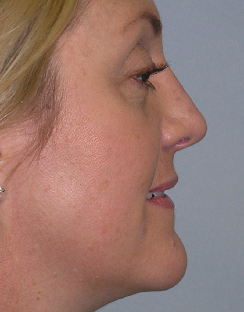 Foundation Rhinoplasty / Crooked Nose Before & After Gallery - Patient 352976 - Image 6