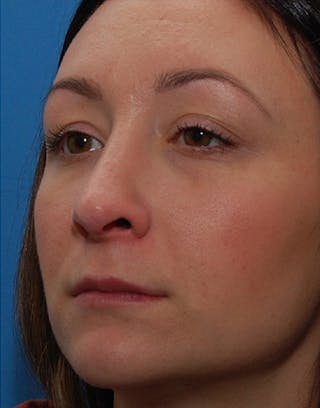 Rhinoplasty Before & After Gallery - Patient 186035 - Image 8