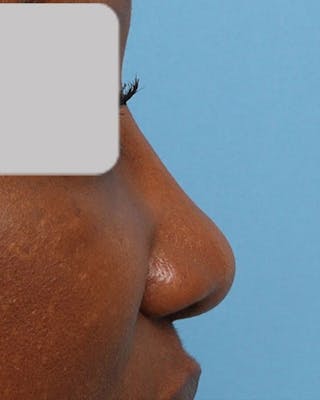 Rhinoplasty Before & After Gallery - Patient 203019 - Image 2