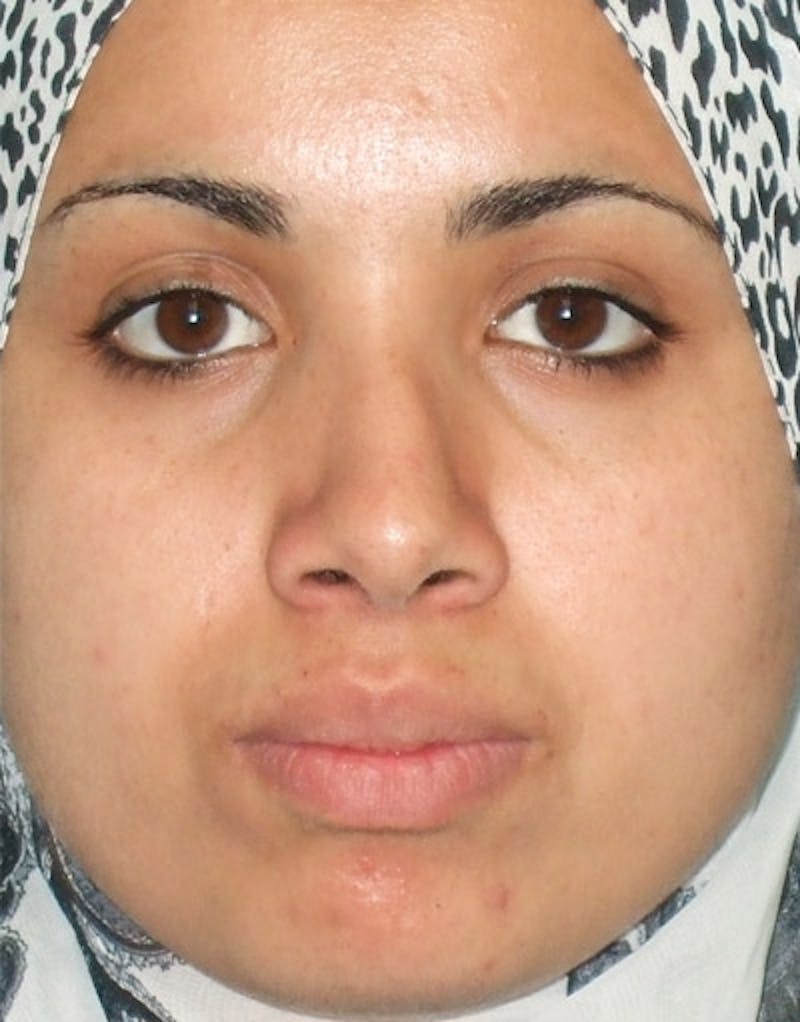 Patient PGiAyO2fQ42wc1SpCeIiBQ - Foundation Rhinoplasty Before & After Photos