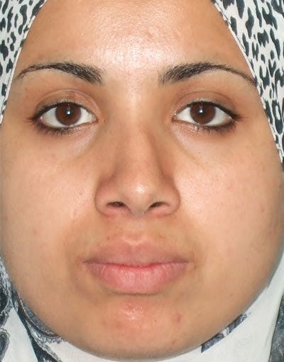 Rhinoplasty Before & After Gallery - Patient 172205 - Image 1