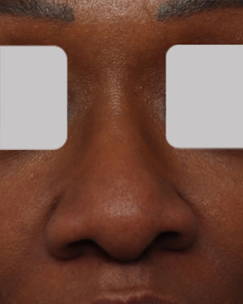 Rhinoplasty  Before & After Gallery - Patient 203019 - Image 3