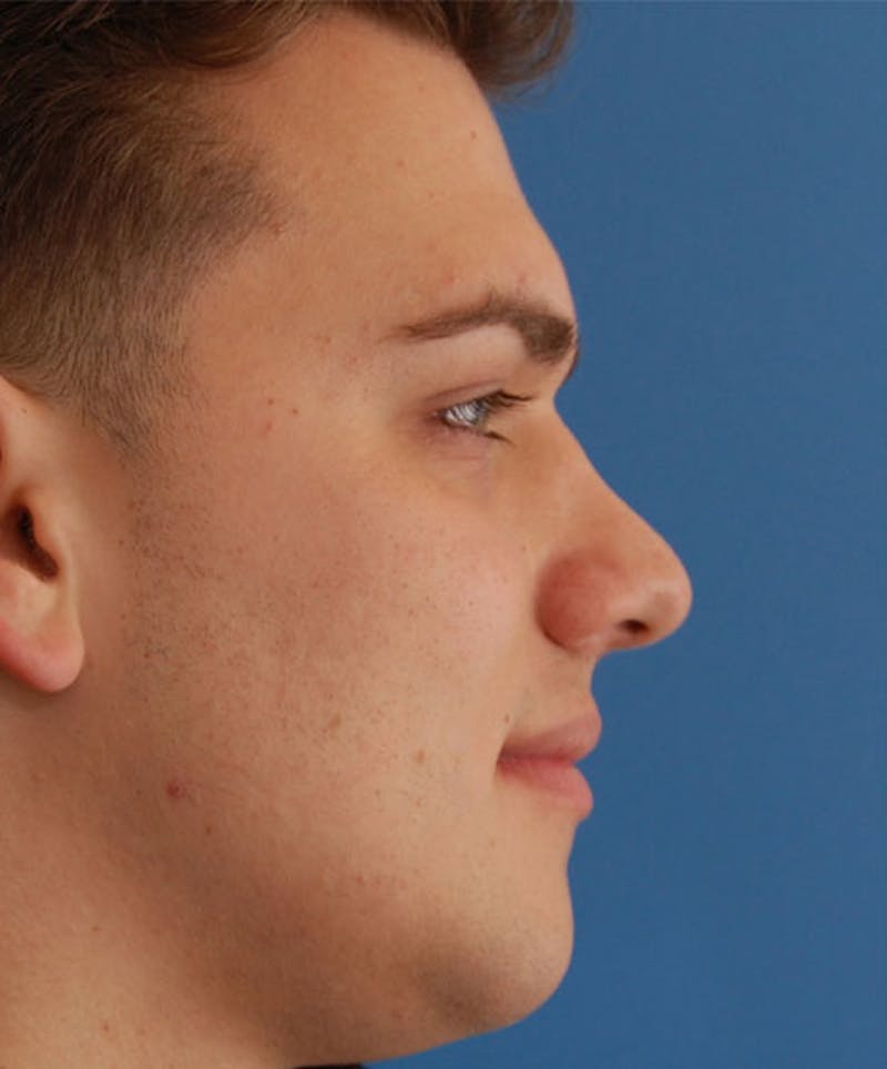 Patient BLJW_U67RWmozQair1o4Mg - Revision Rhinoplasty Before & After Photos