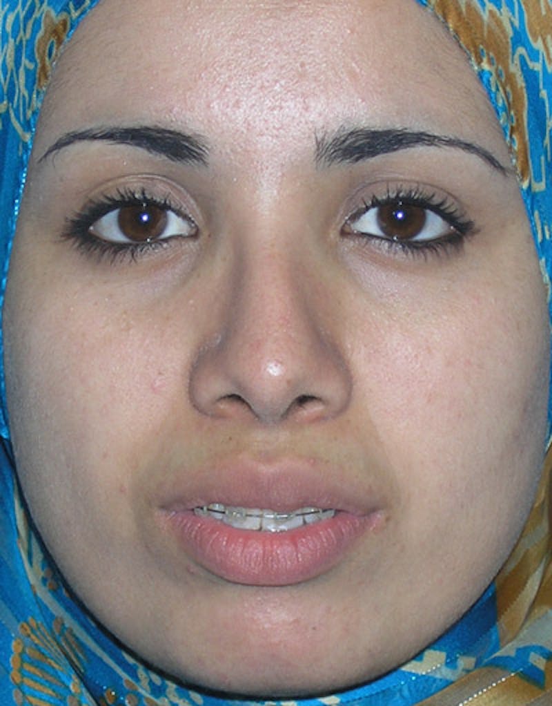 Foundation Rhinoplasty / Crooked Nose Before & After Gallery - Patient 888125 - Image 2