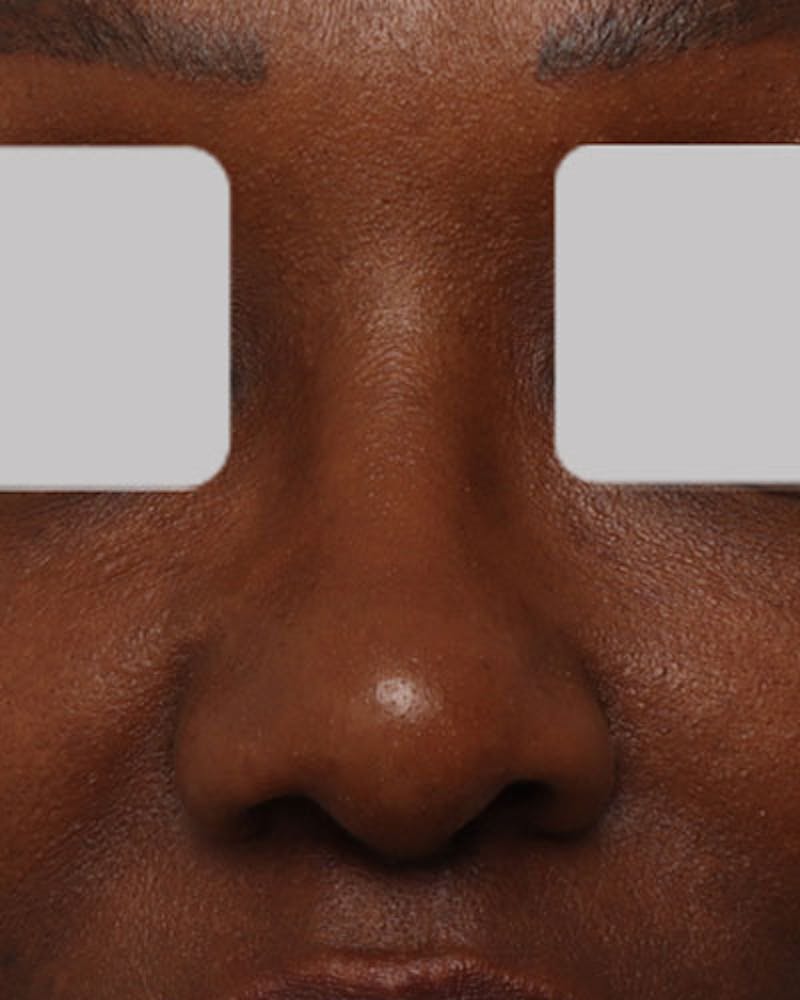 Rhinoplasty  Before & After Gallery - Patient 203019 - Image 4