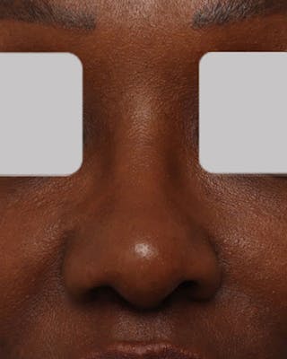 Rhinoplasty Before & After Gallery - Patient 203019 - Image 4