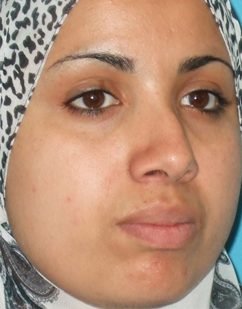 Rhinoplasty  Before & After Gallery - Patient 172205 - Image 3