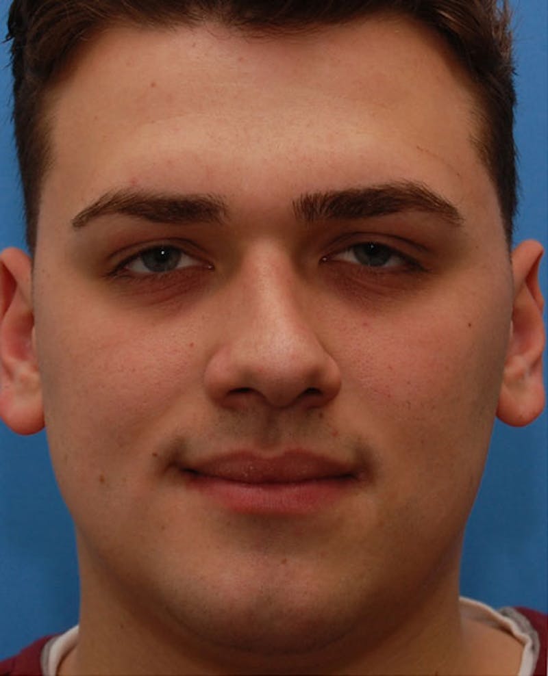 Favorite Revision Rhinoplasty Before & After Gallery - Patient 396626 - Image 3