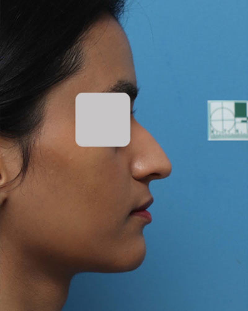 Rhinoplasty Before & After Gallery - Patient 111597 - Image 1