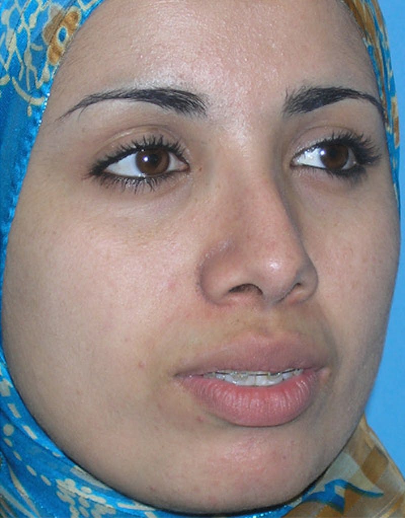 Foundation Rhinoplasty / Crooked Nose Before & After Gallery - Patient 888125 - Image 4