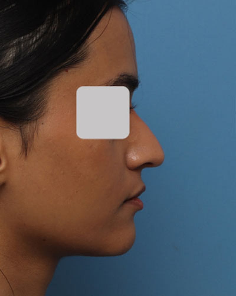 Rhinoplasty Before & After Gallery - Patient 111597 - Image 2
