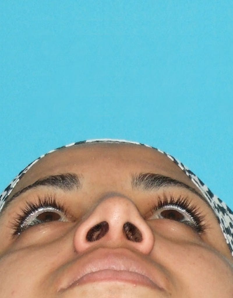 Rhinoplasty  Before & After Gallery - Patient 172205 - Image 5