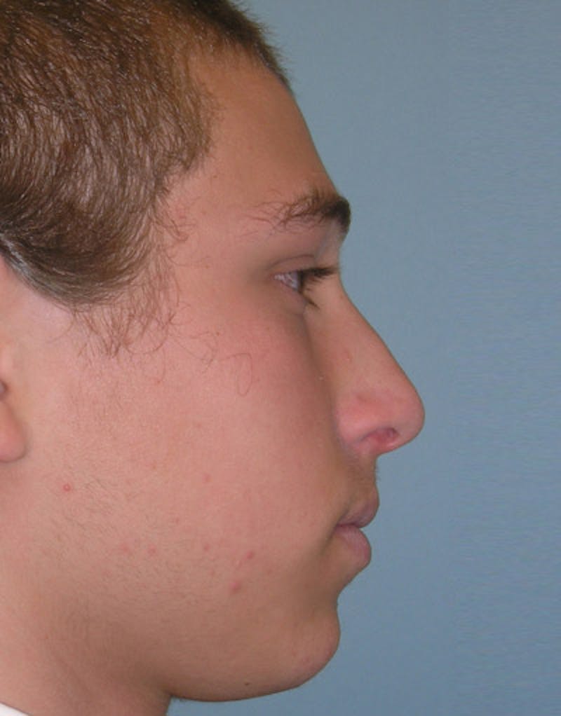 Patient AAbwRrxFTIiJrokPRsFSwg - Male Rhinoplasty Before & After Photos