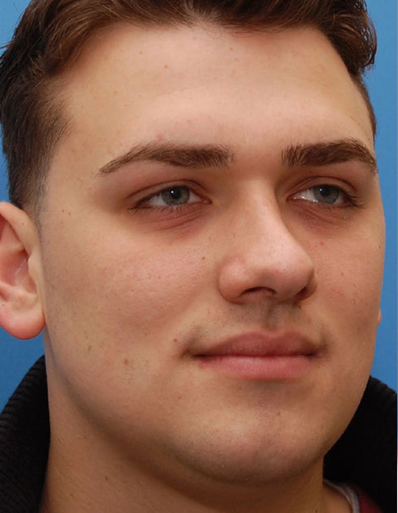 Favorite Revision Rhinoplasty Before & After Gallery - Patient 396626 - Image 5