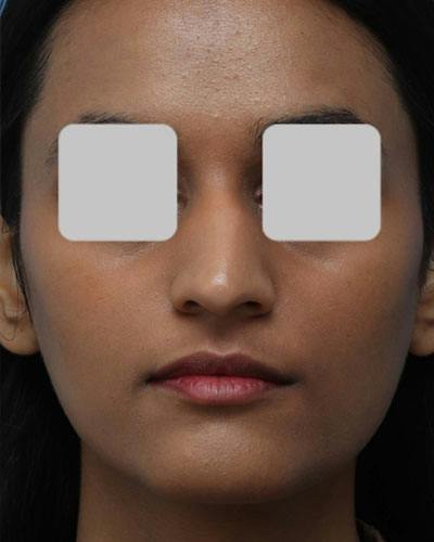 Rhinoplasty Before & After Gallery - Patient 284001 - Image 1