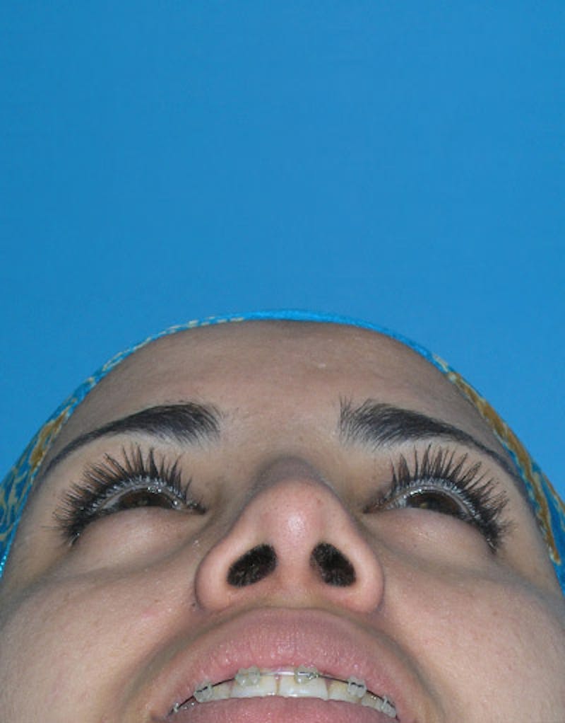 Rhinoplasty  Before & After Gallery - Patient 172205 - Image 6