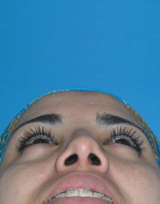 Rhinoplasty Before & After Gallery - Patient 172205 - Image 6